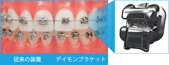 Comparison of different types of braces